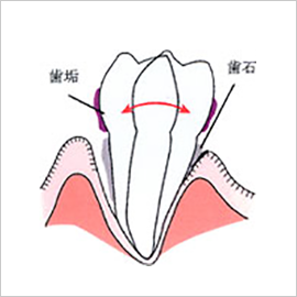 重度歯周炎