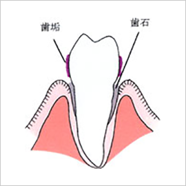 中等度歯周炎