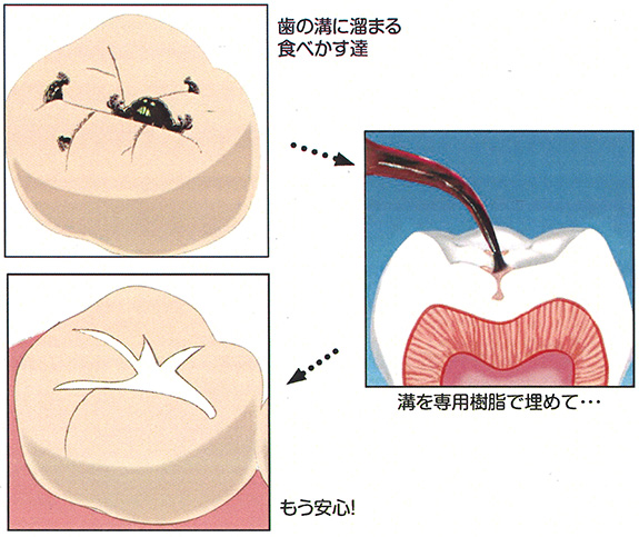 お子様を守るシーラントとは？