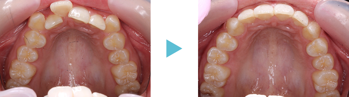 矯正歯科　症例