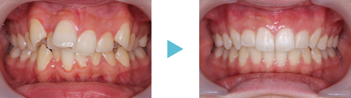 矯正歯科　症例