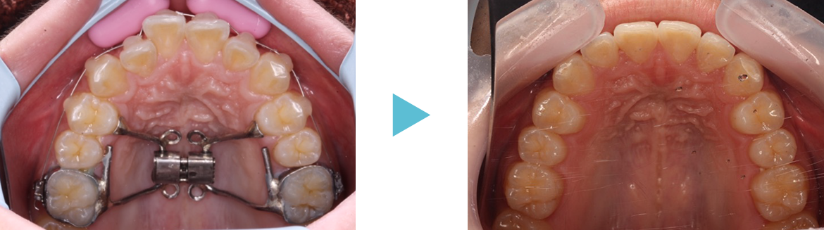 矯正歯科　症例