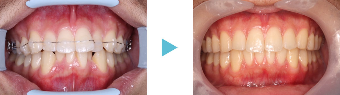 矯正歯科　症例