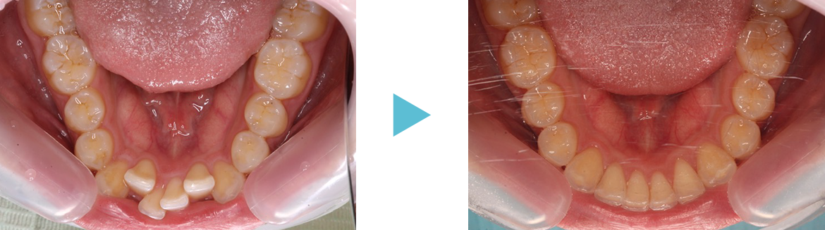 矯正歯科　症例