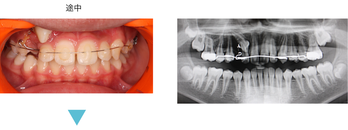 矯正歯科　症例