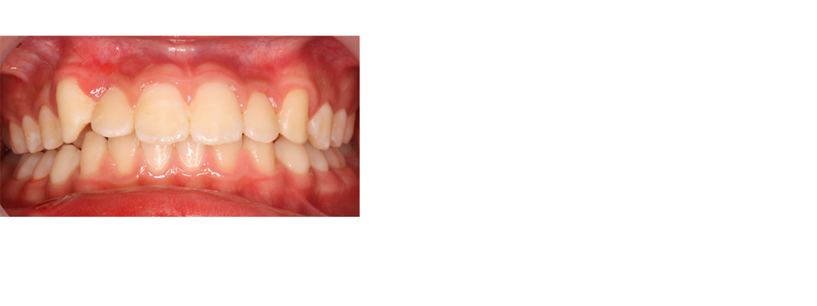 矯正歯科　症例