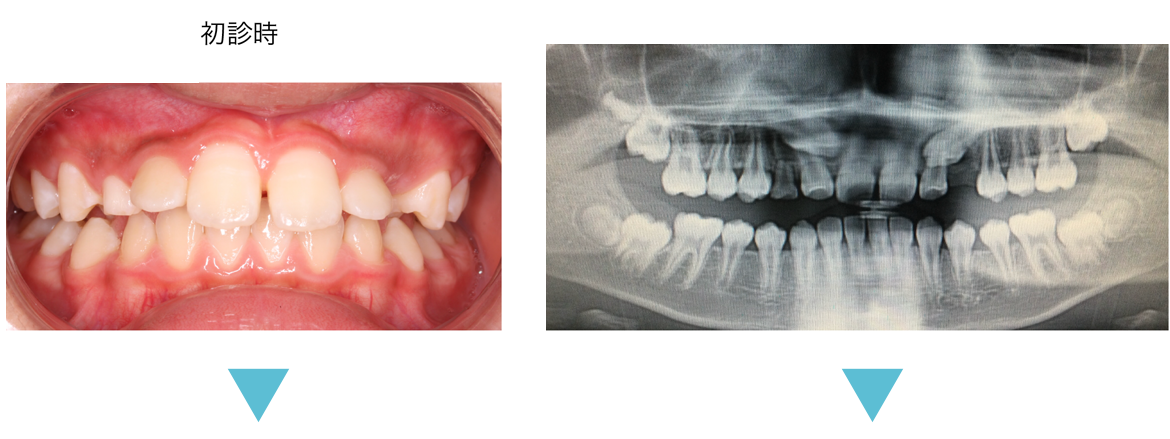 矯正歯科　症例