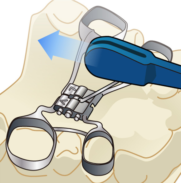 固定式拡大装置