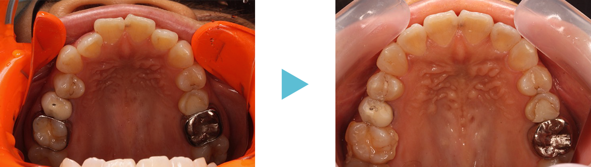 開咬（前歯に隙間があるケース）