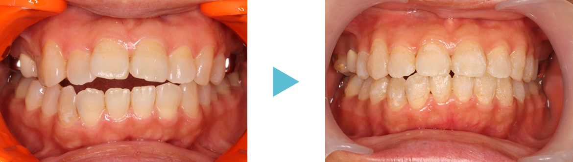 開咬（前歯に隙間があるケース）