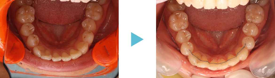 開咬（前歯に隙間があるケース）
