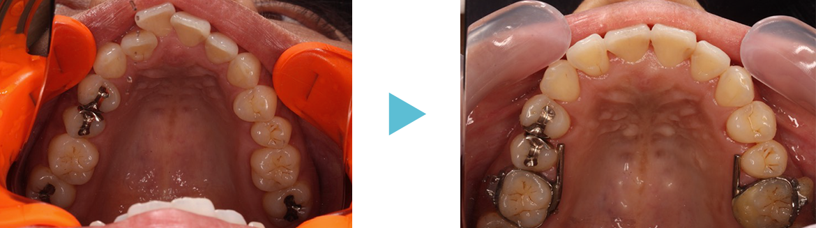 鳥貌（出っ歯で唇が閉まりにくいケース）