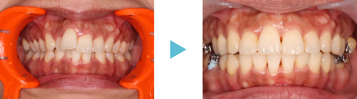 鳥貌（出っ歯で唇が閉まりにくいケース）