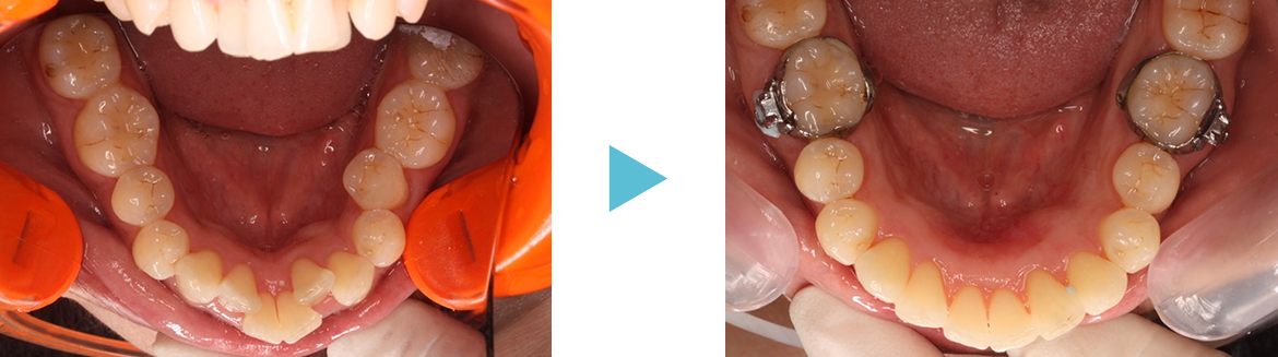 鳥貌（出っ歯で唇が閉まりにくいケース）