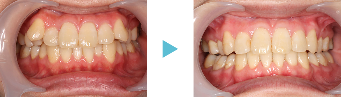 矯正歯科　症例