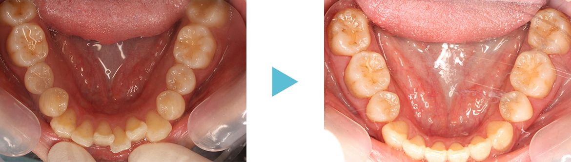 矯正歯科　症例