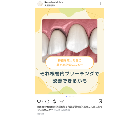 根管内ブリーチング